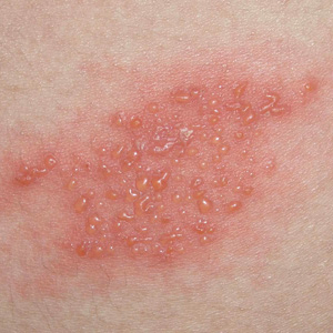 What Does Herpes Outbreak Look Like in Stages? Recognizing the Six Stages